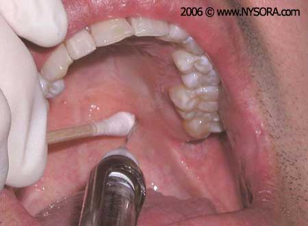 Description: http://www.nysora.com/files/2013/oral-maxillofacial-regional-anesthesia/14b.jpg