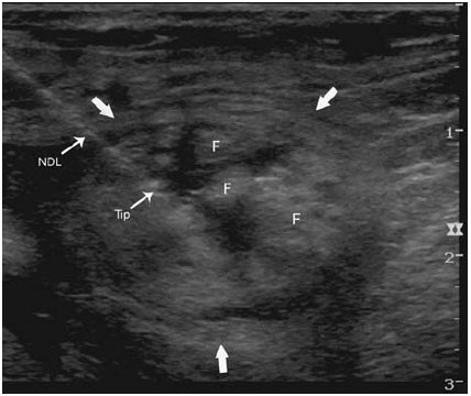 Ultrasound-image